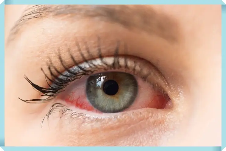 눈 실핏줄 터짐, 원인 및 증상 예방법