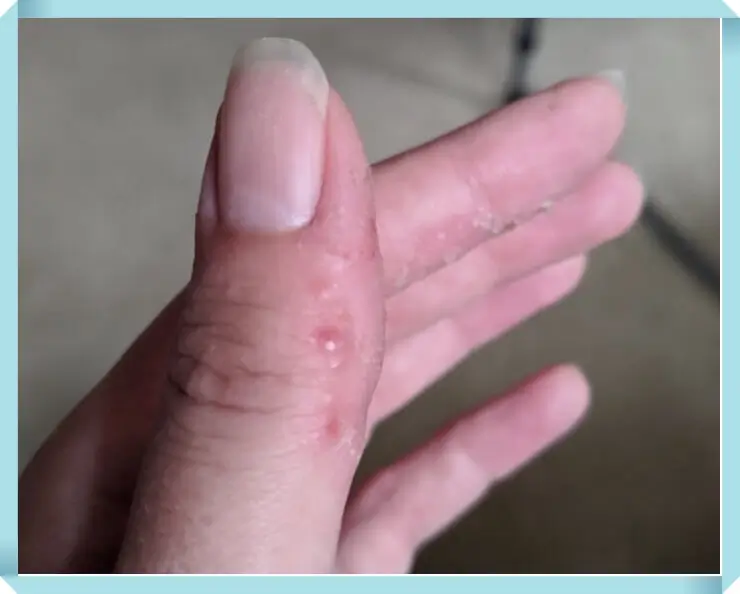 손가락 한포진 원인 및 증상 치료법