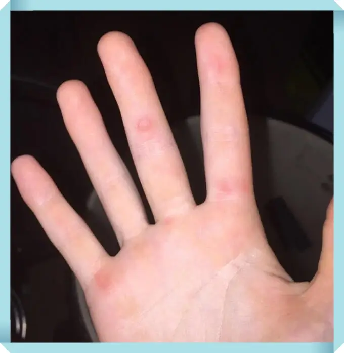 손가락 한포진 원인 및 증상