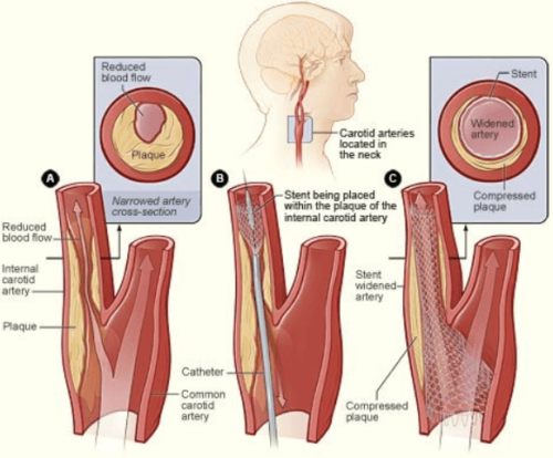 symptoms of carotid stenosis